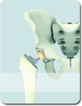 Reconstructive and Osteoarthritis surgery