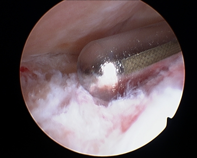 Synovectomie endoscopique d'un hygroma du coude