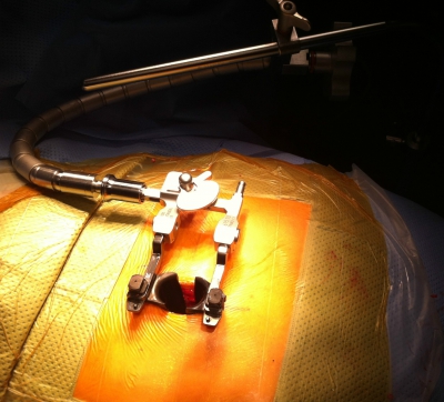 Hernie discale lombaire par voie Mini Invasive (la microdiscectomie)  
